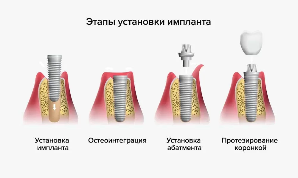 Планирование восстановления нескольких зубов