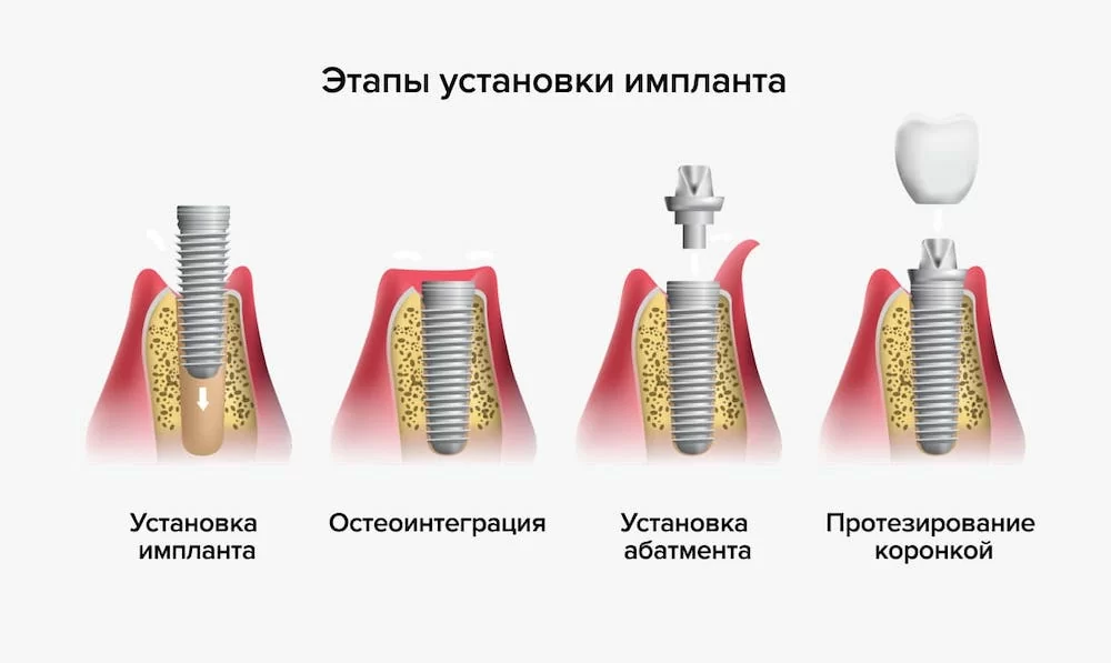 Диагностическое изображение для планирования имплантации